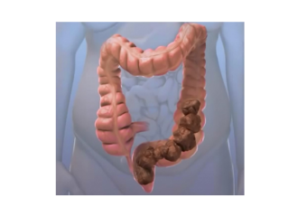 Intestino preso