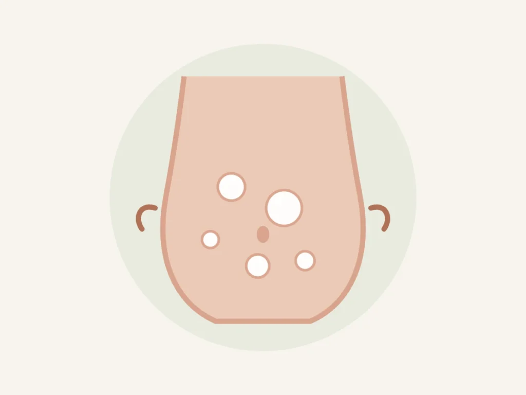 Ilustração de abdômen distendido com bolhas de gás representando barriga inchada