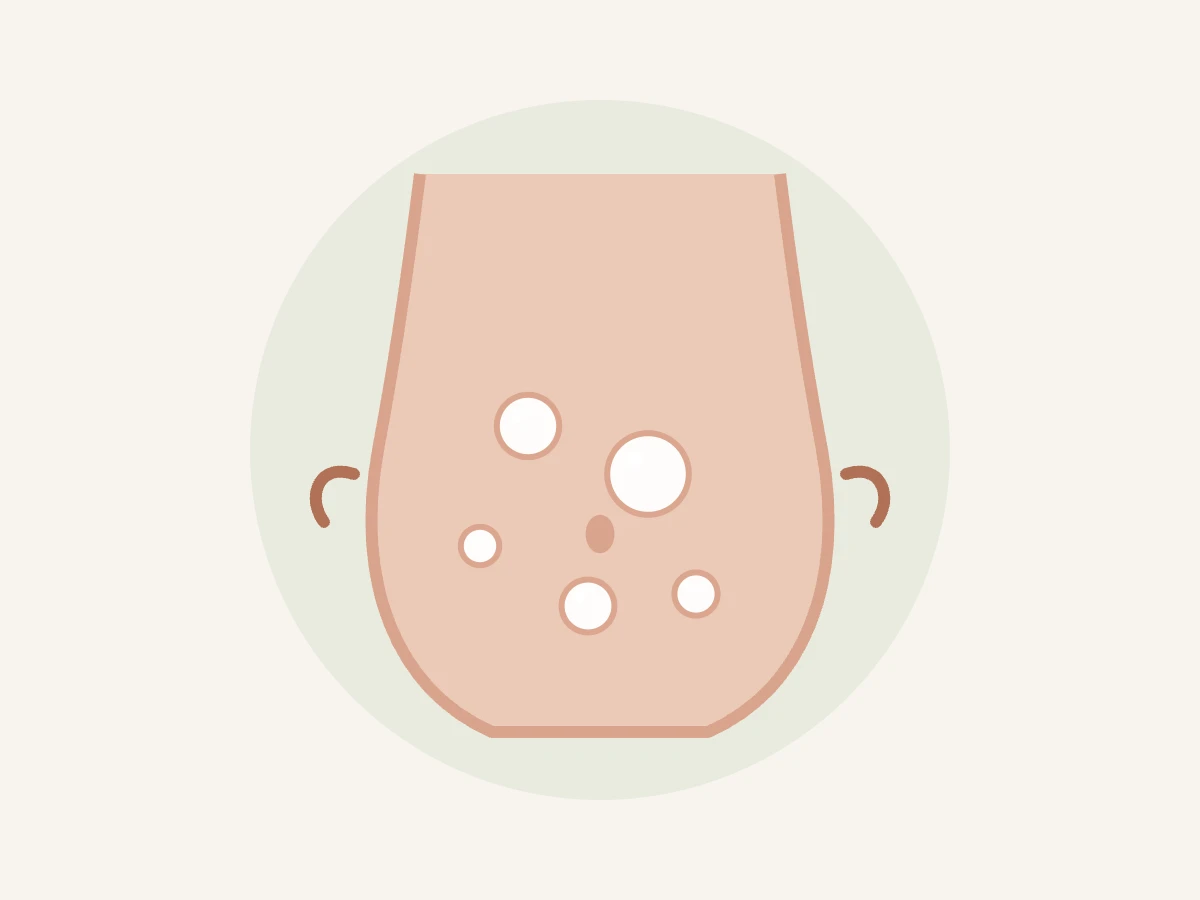 Ilustração de abdômen distendido com bolhas de gás representando barriga inchada