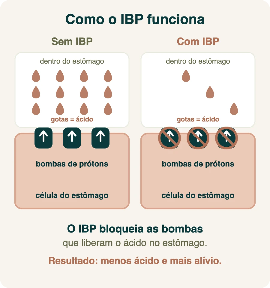 Infográfico de como o IBP funciona: sem IBP, as bombas de prótons das células do estômago liberam muito ácido; com IBP, as bombas ficam bloqueadas e sai pouco ácido