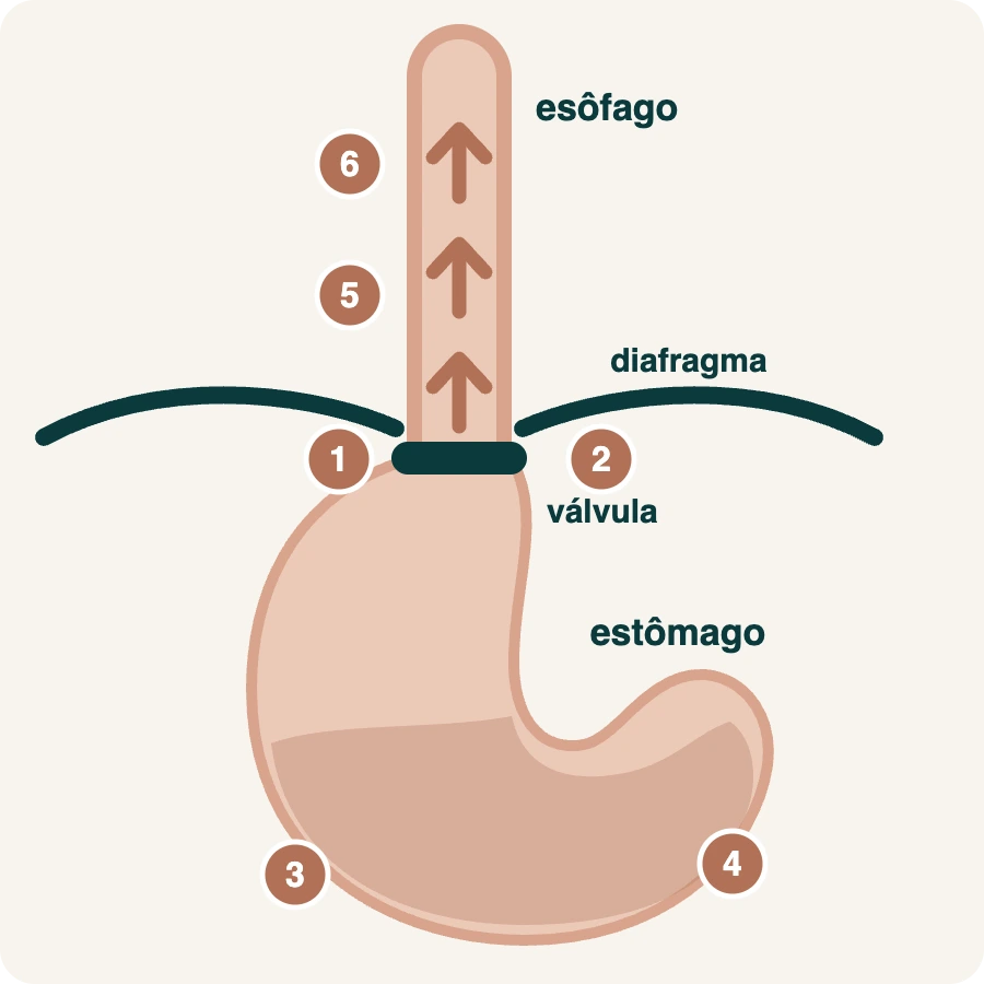Infográfico mostrando o esôfago, a válvula entre esôfago e estômago, o diafragma e o estômago, com os seis fatores que causam o refluxo gastroesofágico