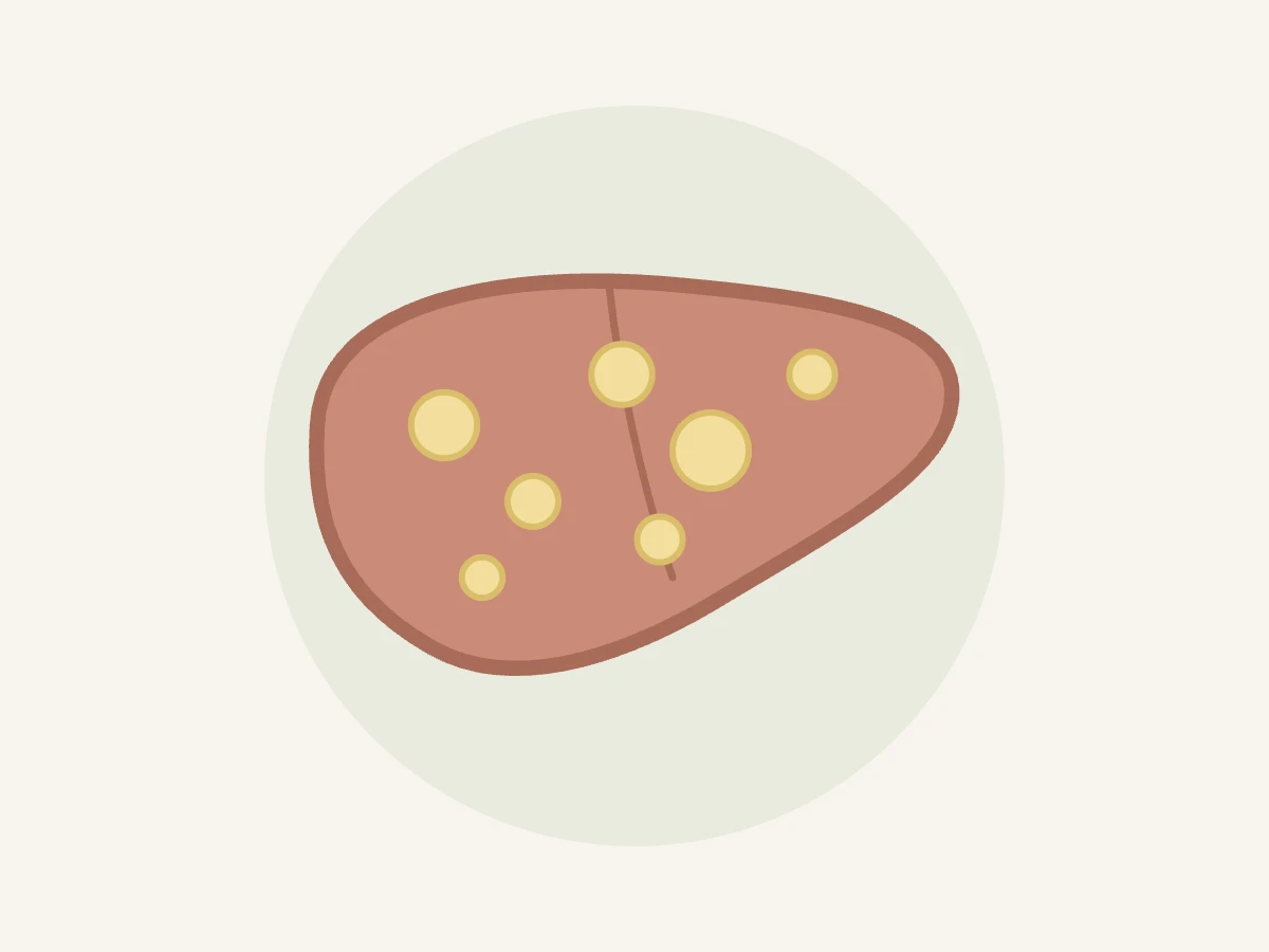 Ilustração do fígado com gotículas de gordura representando esteatose hepática
