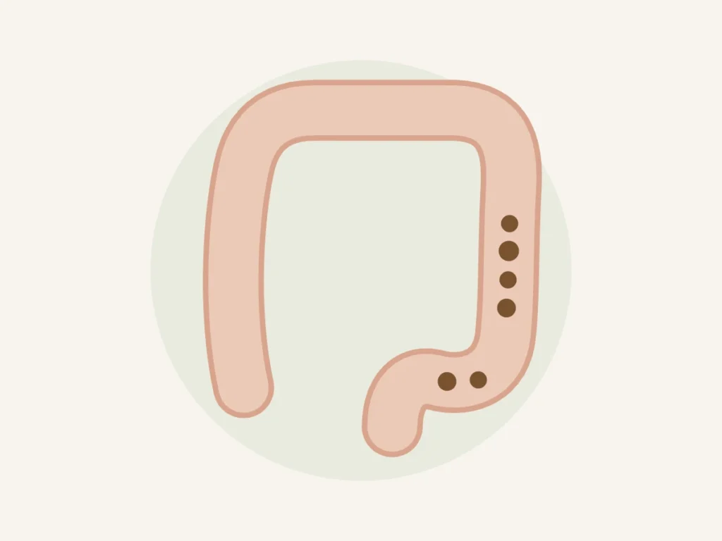 Ilustração do intestino grosso com fezes retidas representando intestino preso