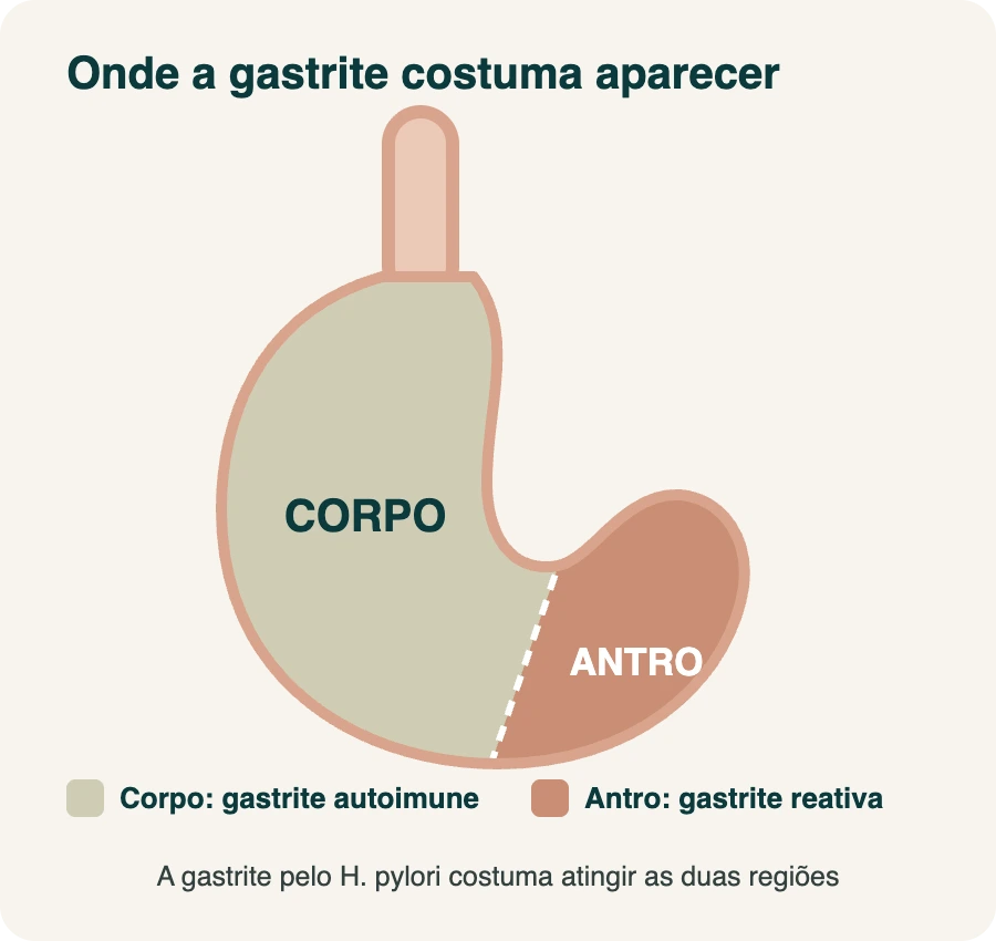 Infográfico do estômago mostrando o corpo, onde aparece a gastrite autoimune, e o antro, onde aparece a gastrite reativa. A gastrite pelo H. pylori atinge as duas regiões