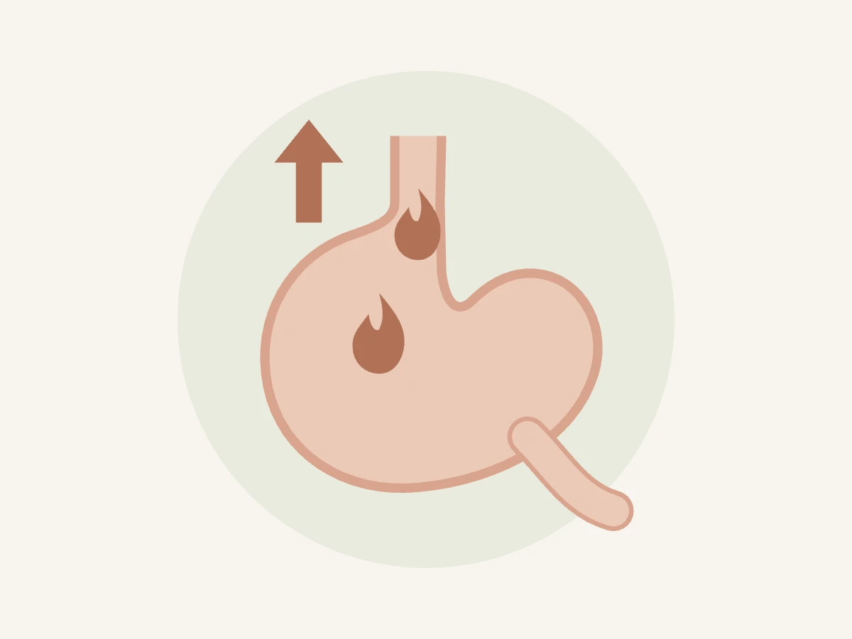 Ilustração do estômago com seta para cima representando refluxo gastroesofágico